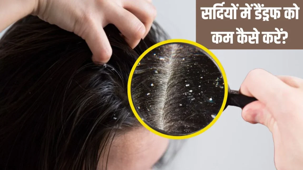 सर्दियों में डैंड्रफ से है परेशान? तो जानिए इसको कम करने का घरेलू उपाय…!